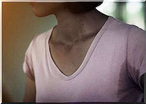 A picture showing a woman with hyperhidrosis in a shirt with large sweaty armpit spots.